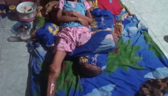 Sak’iyah Harus Kehilangan Kakinya Di Vonis Tumor Ganas, Sang Suami Darwin Habis Akal