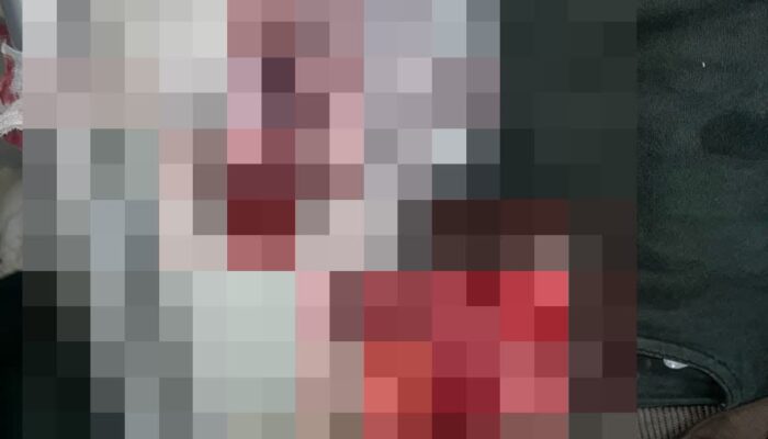 Terjepit Mesin Pabrik PT. Tri Excella Harmony, Jari Tangan Seorang Buruh Terancam Cacat Permanen
