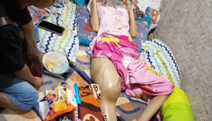 Miranti, Siswi SMP Kelas 3 Kini Tak Bisa Berjalan Usai Operasi, Keluarga Menanti Uluran Tangan Pemerintah